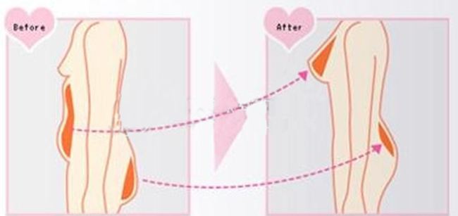 广州鸿业做自体隆胸案例 对比图