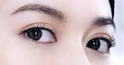 韩式双眼皮手术的效果怎么样
