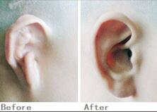 衢州雪荣耳廓畸形的原因及修复的方法