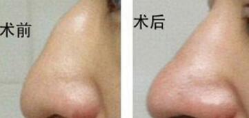 太原新世纪驼峰鼻矫正术的两种方法