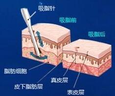 腰腹吸脂术 找回自信心