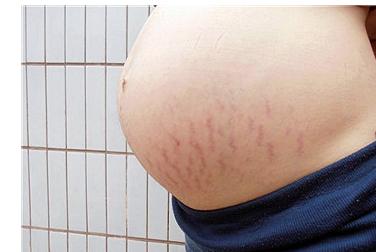北京联合丽格果酸换肤去妊娠纹的优缺点