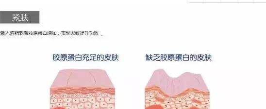 面部吸脂瘦脸用哪种方法