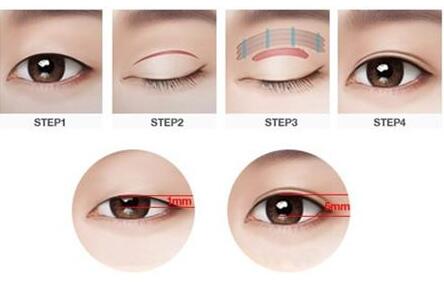 天津滨海医院做双眼皮修复手术的特点