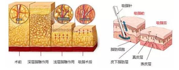 抽自己腹部的脂肪整形安全吗