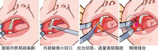 去颊脂垫术后表情还能控制住吗