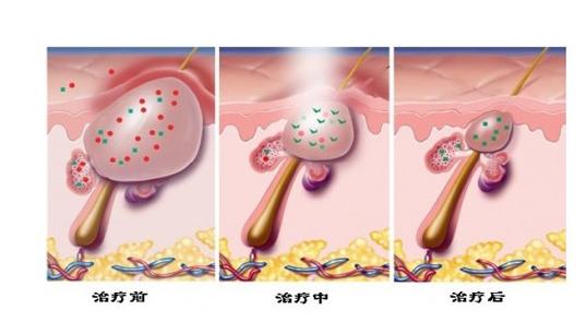 激光去青春痘会复发吗