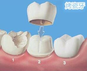 烤瓷牙掉了还能重新粘上吗