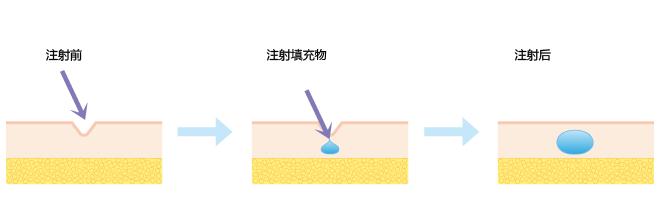 爱贝芙除皱的植入材料安全吗