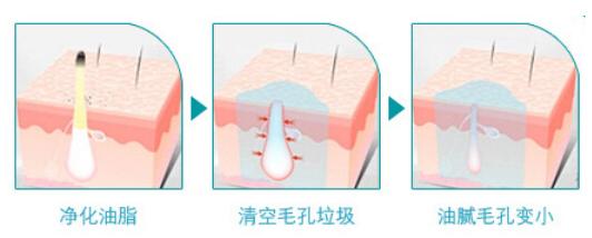 光子嫩肤适不适用于痘痘肌呢