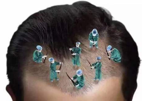 北京史三八头发移植手术的优点