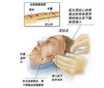 面部悬吊除皱的切口是藏哪里呢