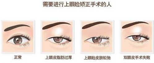 上海欧华整形医院眼睑下垂矫正对比图 能维持多久