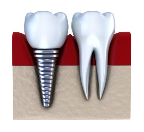 牙齿缺失怎么办 修复方法哪种好