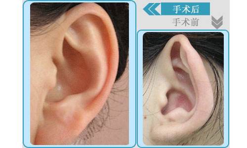 武汉丽尔耳廓畸形矫正 家长操心会影响听力吗