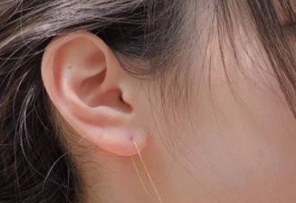 北京沃尔整形副耳切除 让你的耳朵完美无缺