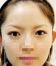 在郑州美眼专业眼部整形医院做的双眼皮 我也是大眼美女