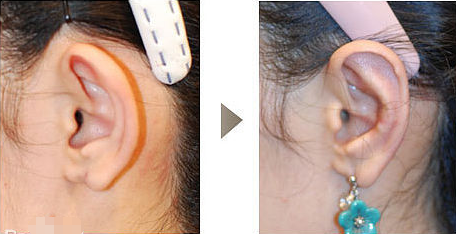 切除副耳安全吗 副耳切除术安全快速还孩子完美耳型