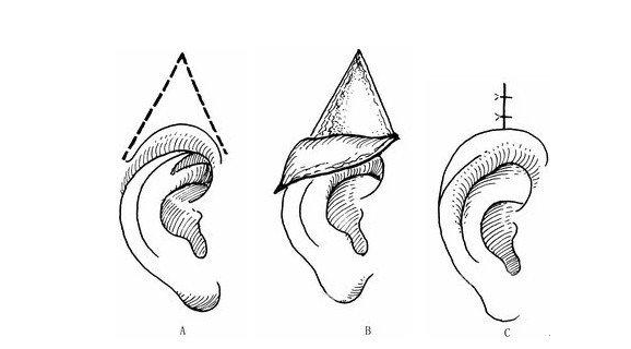 隐耳矫正术能矫正隐耳吗 隐耳矫正让你隐形的耳朵露出来