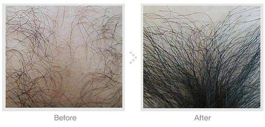 杭州天大毛发移植整形医院阴毛种植 毛发生长更贴近自然