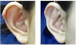 耳廓畸形矫正福州博美整形专家提醒 及时就诊莫失良机