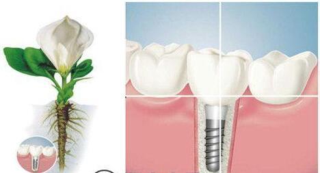 武汉德亚口腔医疗整形种植牙 不损伤周围牙齿，固位稳定