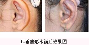 武汉百佳整形医院耳垂畸形修复术 多可达到满意效果