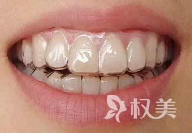北京仁和医院美容整形牙齿科隐形托槽矫正 美观定位精准