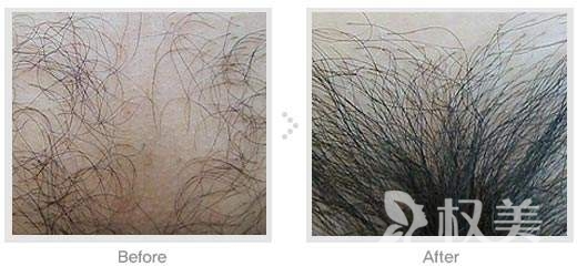 科发源上海植发整形医院阴毛种植 一流技术让毛发再生不再是梦
