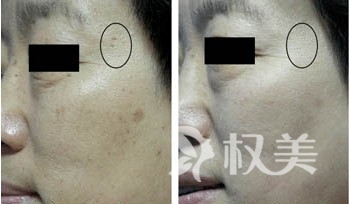 怎样去脸上的老年斑 激光去除老年斑是目前更好的祛斑方法