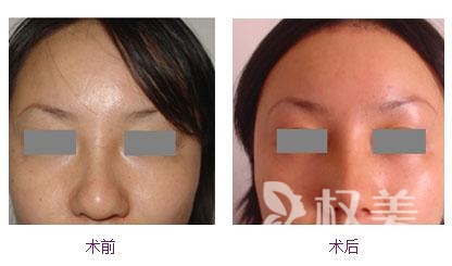 北京鼻头缩小多少钱 手术时一并改善鼻尖鼻翼问题