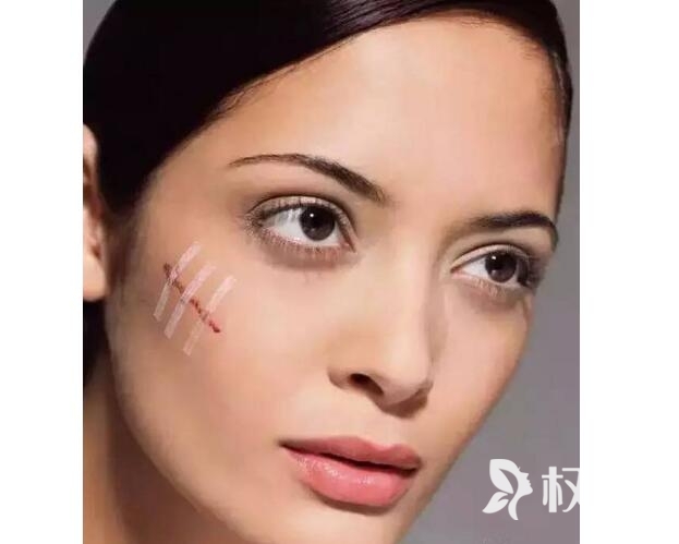 广州疤痕祛除方法有哪些 瘢痕体质请谨慎选择激光祛疤方式