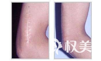 中医治疗疤痕疙瘩有效果吗 激光祛疤痕有哪些优势