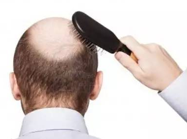 脱发性毛囊炎怎么治疗 它和斑秃有哪些方面的区别