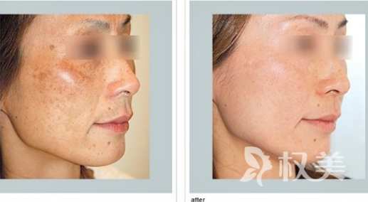 祛斑治疗有哪些食物疗法 光子去斑有效改善肤质