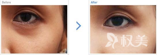 怎么样去除黑眼圈 激光去黑眼圈能避免脸外翻、内陷等副作用