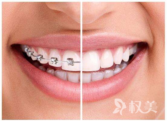 牙齿矫正要多久 具体用时和年龄、方法有关