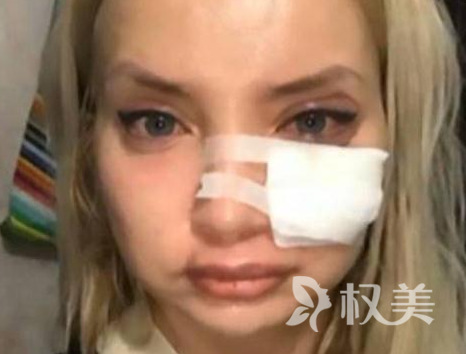 俄罗斯30岁女子Elizaveta Tkachenko找无证朋友注射丰唇 变成了“香肠嘴”