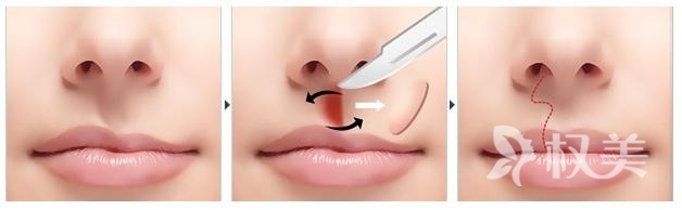 先天性唇腭裂怎么治疗 唇腭裂治愈的几率在显著提高