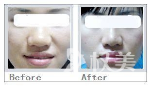 鼻翼肥大怎么办 四种鼻翼状况不同选择的方法不同