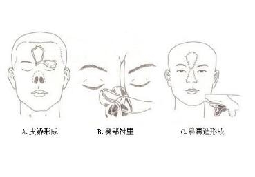 鼻部再造手术的效果怎么样  术后如何护理