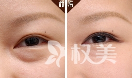 自贡尚美医疗美容整形专家介绍：卧蚕和眼袋的区别