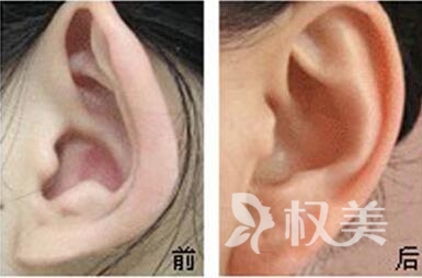 重庆五洲女子激光微整形医院杯状耳整形有什么特点  有哪些矫正方法