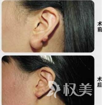 广州美莱医学美容医院做耳垂矫正有哪些方法  需要多少钱