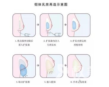 东莞玛丽亚妇产医院中韩整形科乳房再造术的优点  术后注意事项有哪些