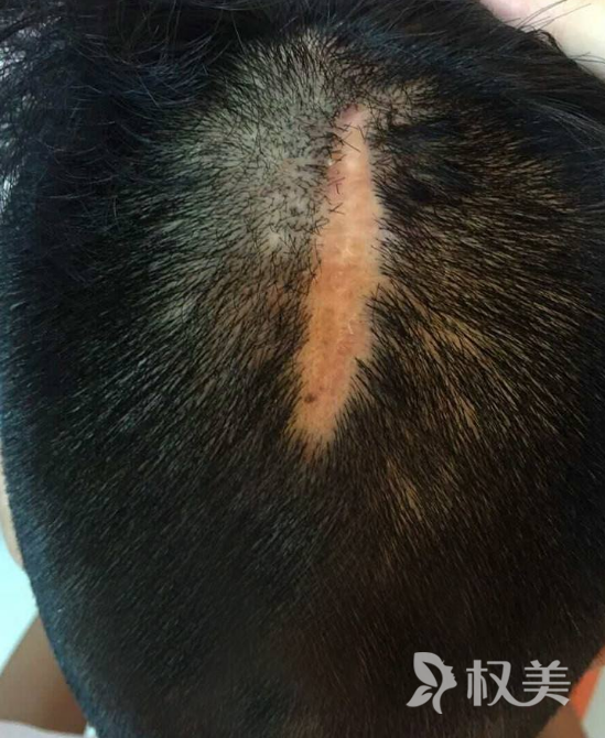 头部有伤疤可以植发吗 广州广大亿美疤痕植发需要多少钱