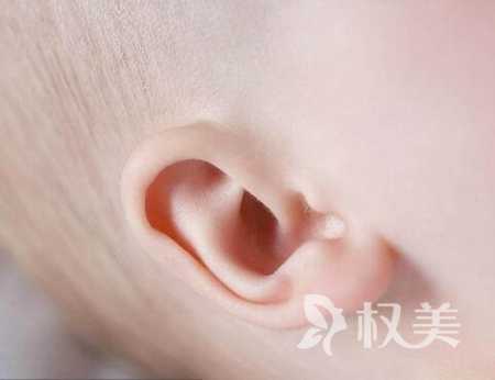 河北医科大学第二医院整形科隐耳怎么矫正 隐耳矫正手术多少钱